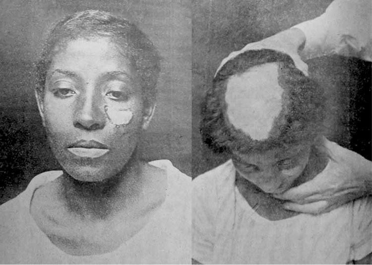 Controle Populacional no Brasil: Entre Políticas Eugenistas e os Direitos Reprodutivos